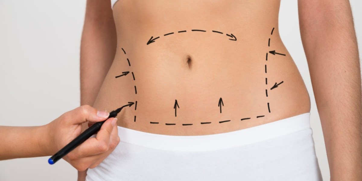 Expert Insights Essential Liposuction Surgery Guide in Dubai