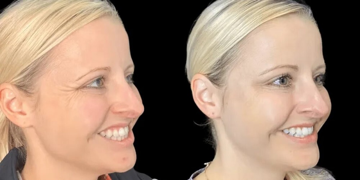 Secrets behind flawless Botox by Best Plastic Surgeons in dubai revealed
