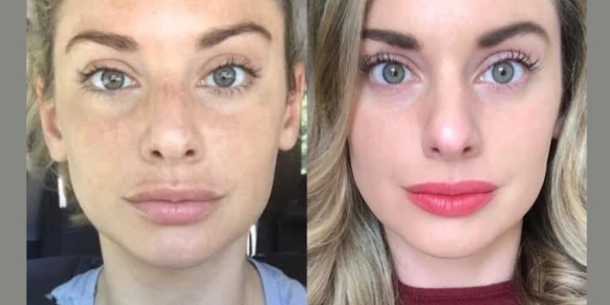 Certified Experts: Best Plastic Surgeon in Dubai for RF Microneedling