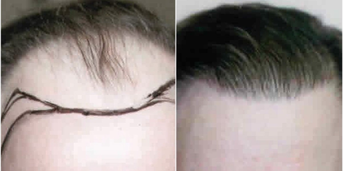 دليل شامل حول أنواع تقنيات زراعة الشعر المتوفرة في دبي