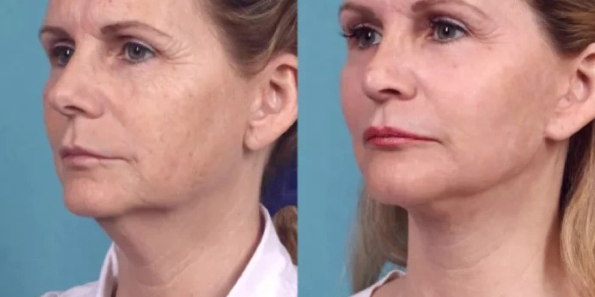 Best Doctors in Dubai Discuss the Most Common Questions About Chemical Peels