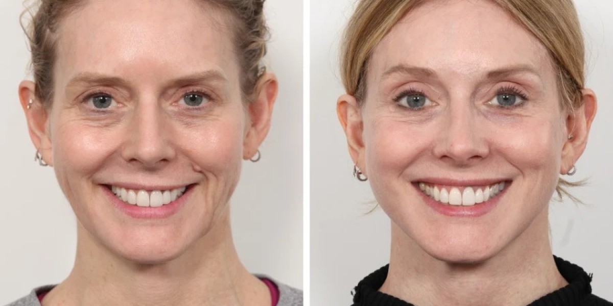 Best Doctors in Dubai Explain Thread Lift for All Ages
