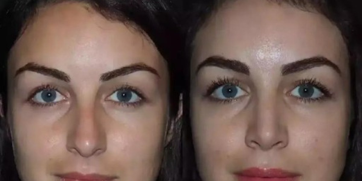 Best Rhinoplasty Surgeon in Dubai: Transform Your Look Today