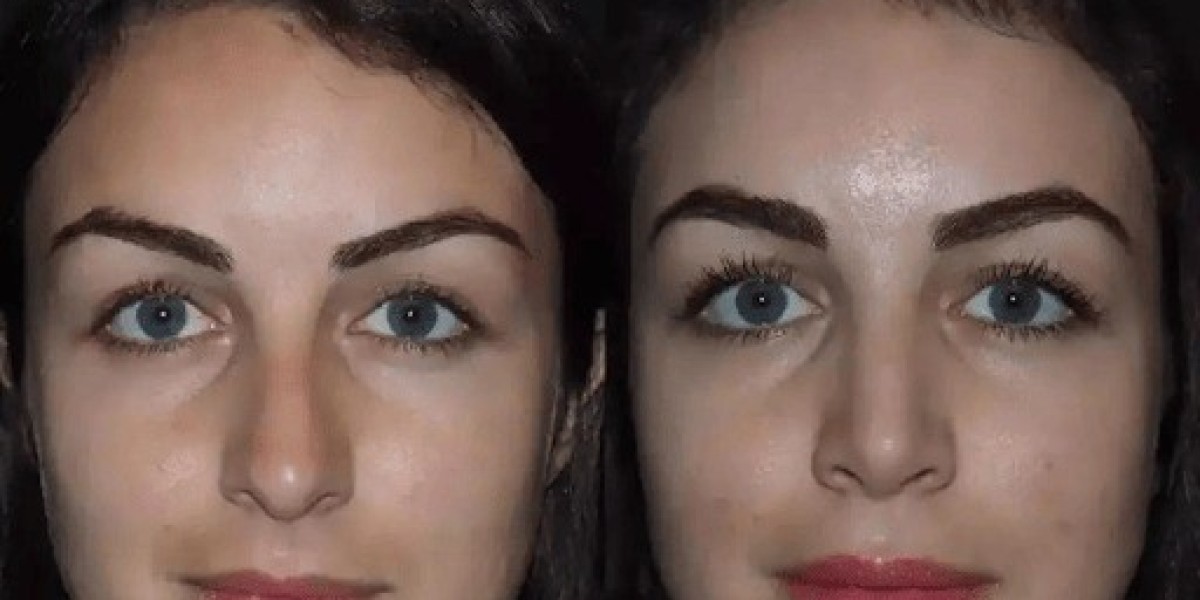 Rhinoplasty in Dubai for Better Shape and Breathing