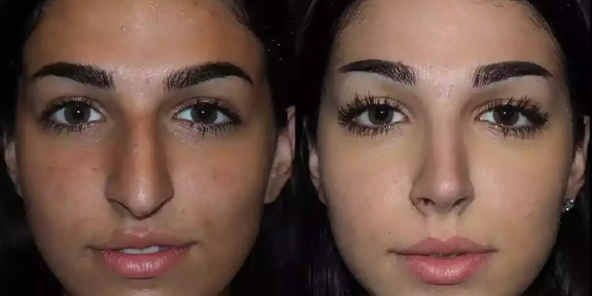 Nose Surgery in Dubai: How to Choose the Right Surgeon