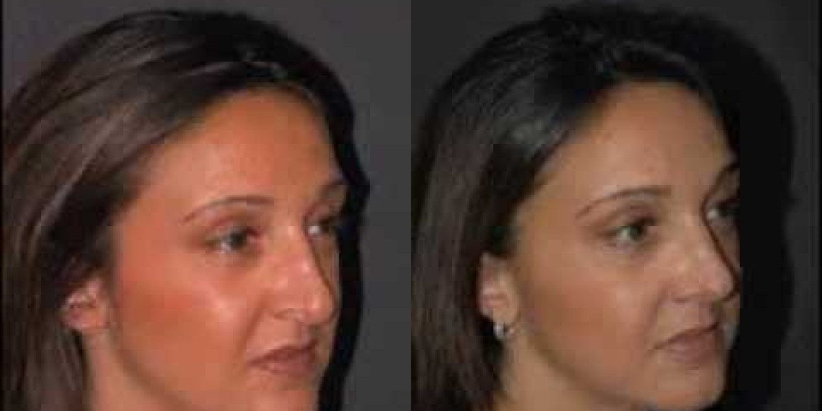 مخاطر وفوائد تجميل الأنف: حقائق يقدمها أطباء دبي