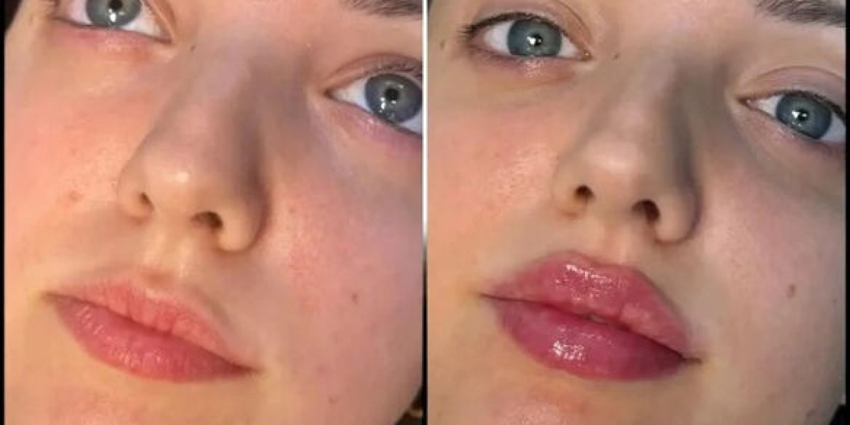 Lift and Contour with Fillers by Best Doctors in dubai