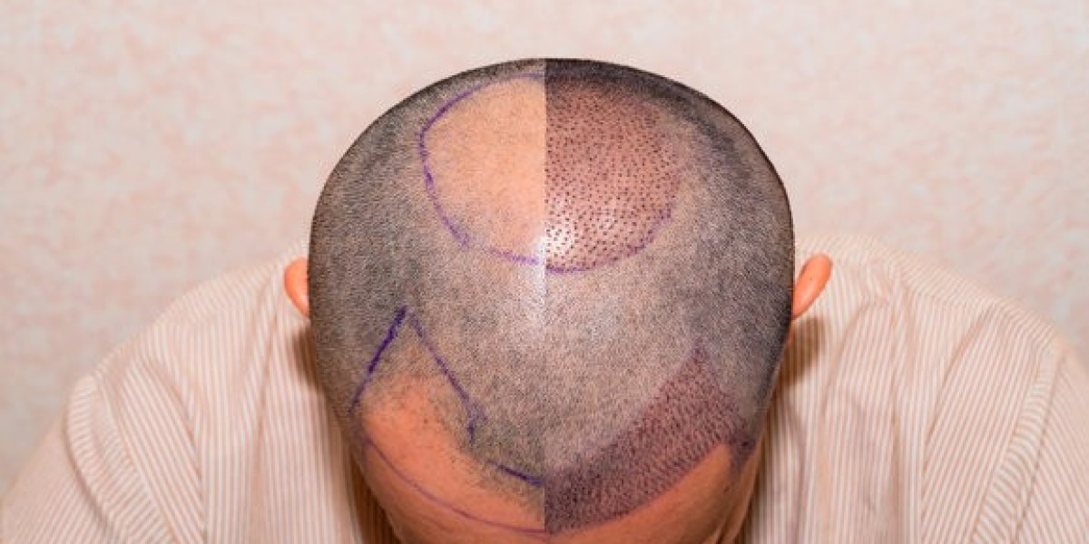 مقارنة شاملة: ما الذي تحصل عليه مقابل تكلفة زراعة الشعر في دبي؟