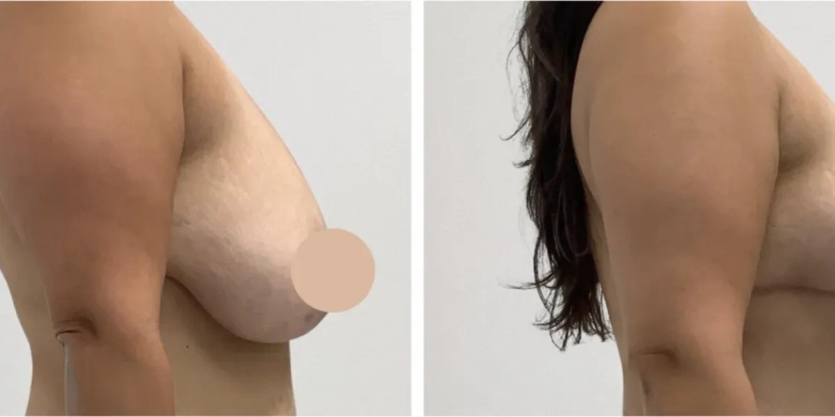Premium Breast Lift Services by Best Doctors in Dubai