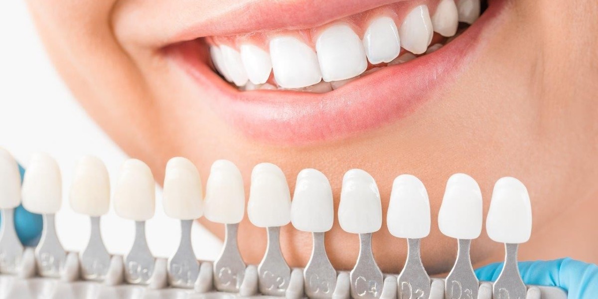 Veneers Dubai: A Complete Guide to a Perfect Smile