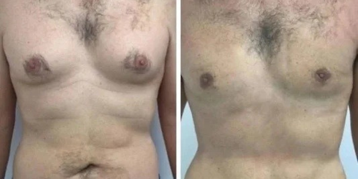 Best Gynecomastia Surgeon in Dubai: How Expertise Impacts Safety and Surgical Precision 
