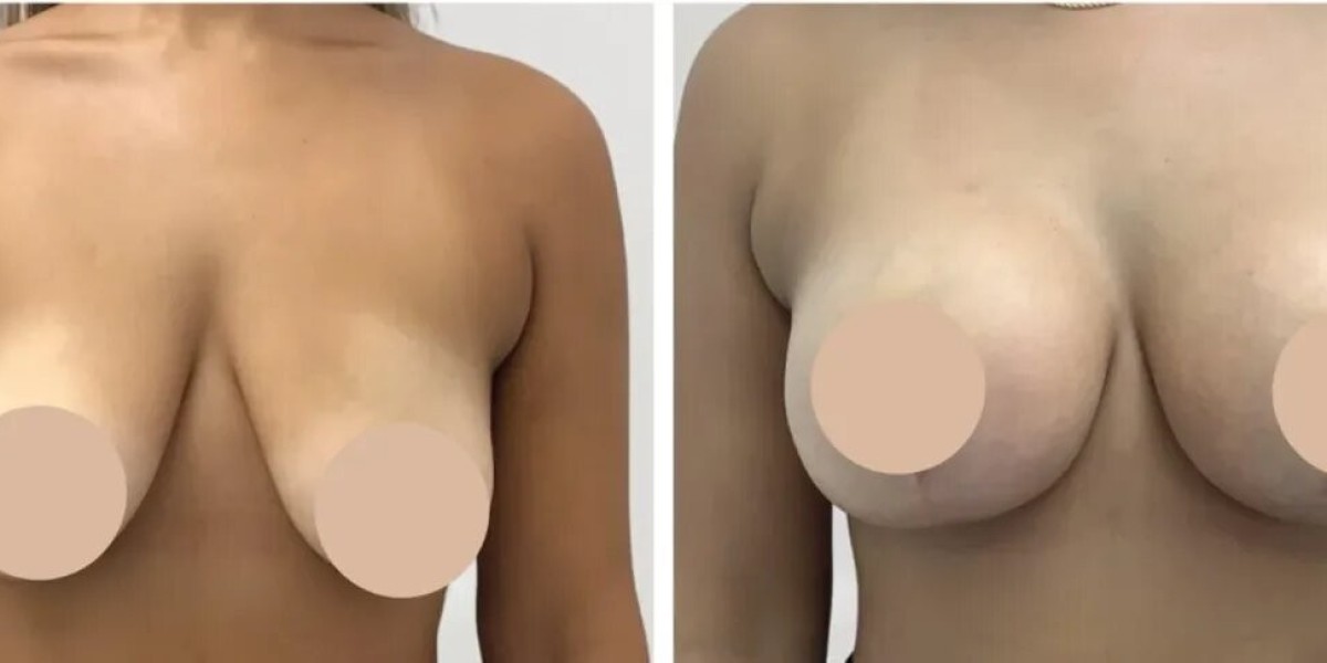 Get the Best Breast Reduction with Best Doctors in Dubai