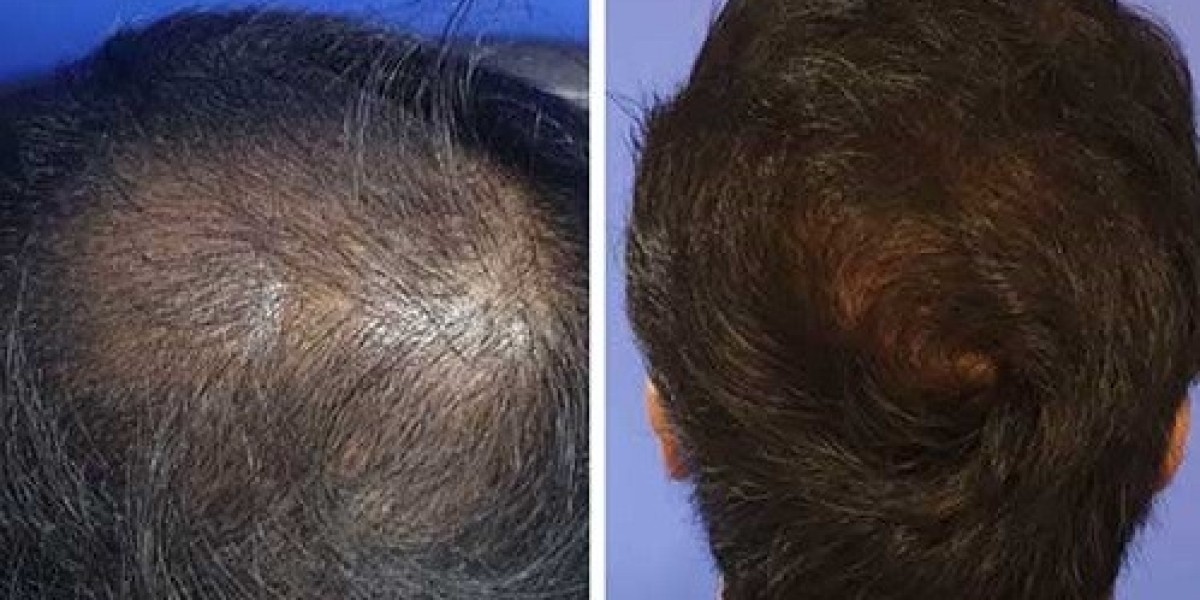 5 أسئلة يجب أن تطرحها قبل إجراء زراعة الشعر في دبي