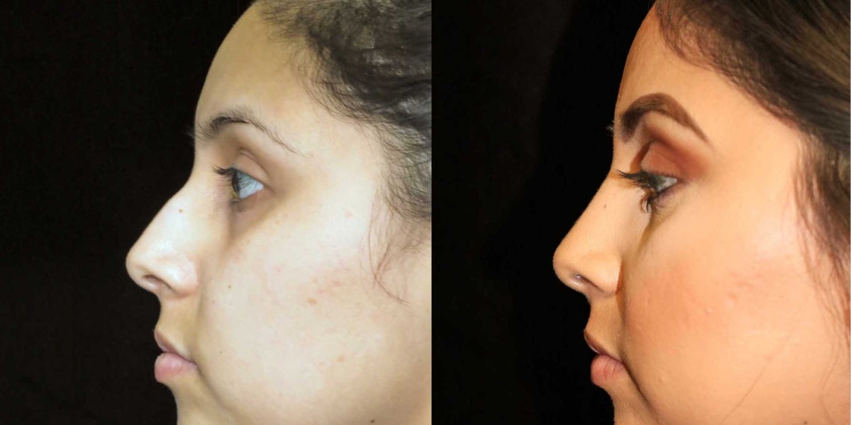 كيف تختار أفضل جراح لتجميل الأنف في دبي؟