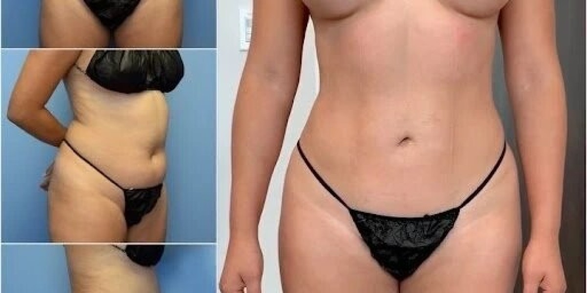 Reveal Your Best Shape with Body Contouring in Dubai