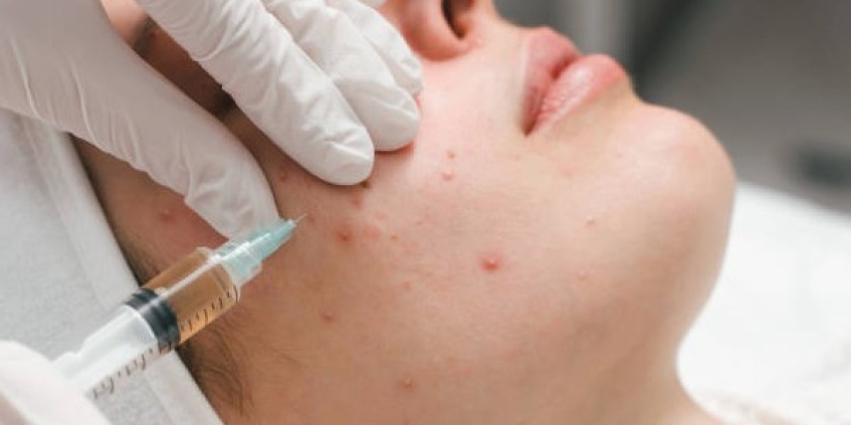 What Dermatologists Recommend as the Best Treatment for Acne Scars
