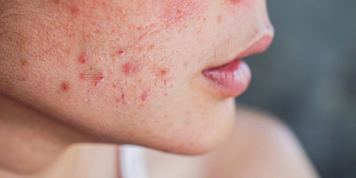 Understanding the Benefits of Professional Acne Treatment in Dubai