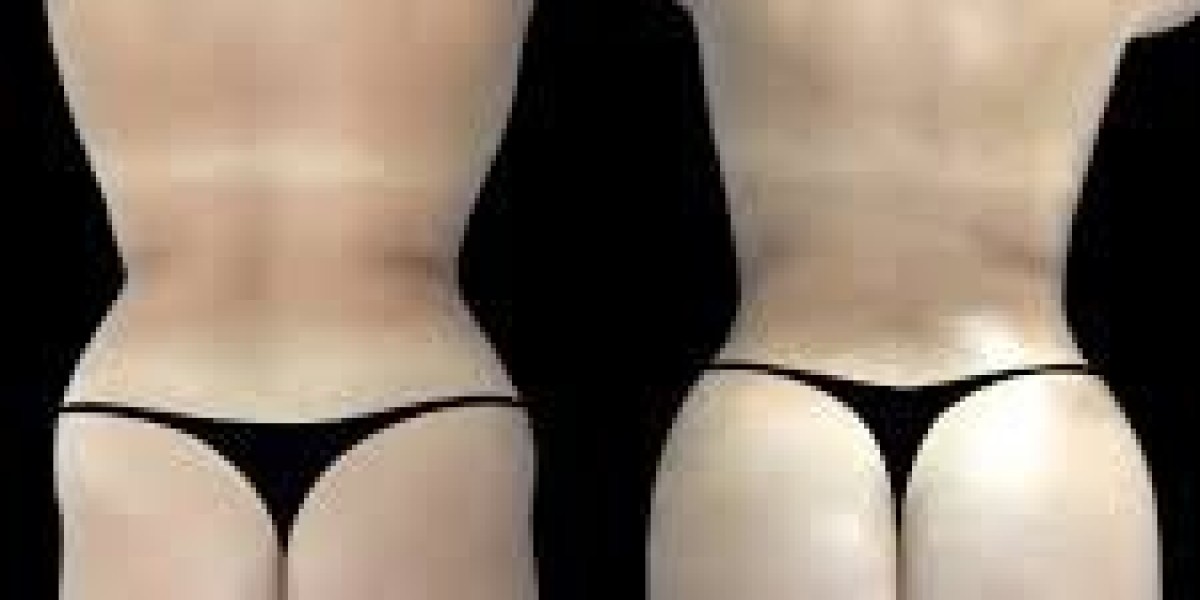 Butt Fat Transfer in Dubai for Enhanced Silhouette