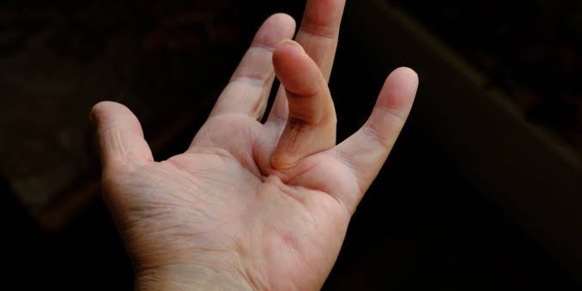 What Is Viking's Disease? A Complete Guide to Dupuytren's Contracture