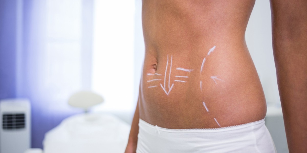Tummy Tuck Surgery Dubai: Frequently Asked Questions