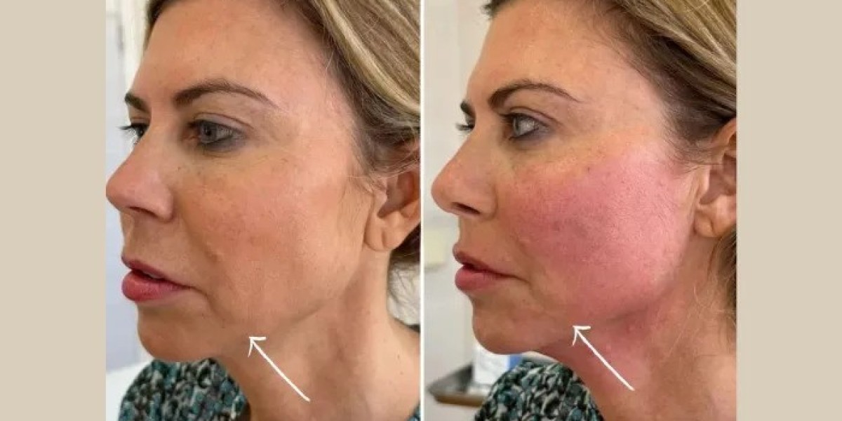 Best Doctors in dubai Performing Advanced Endolift Neck Tightening Treatments