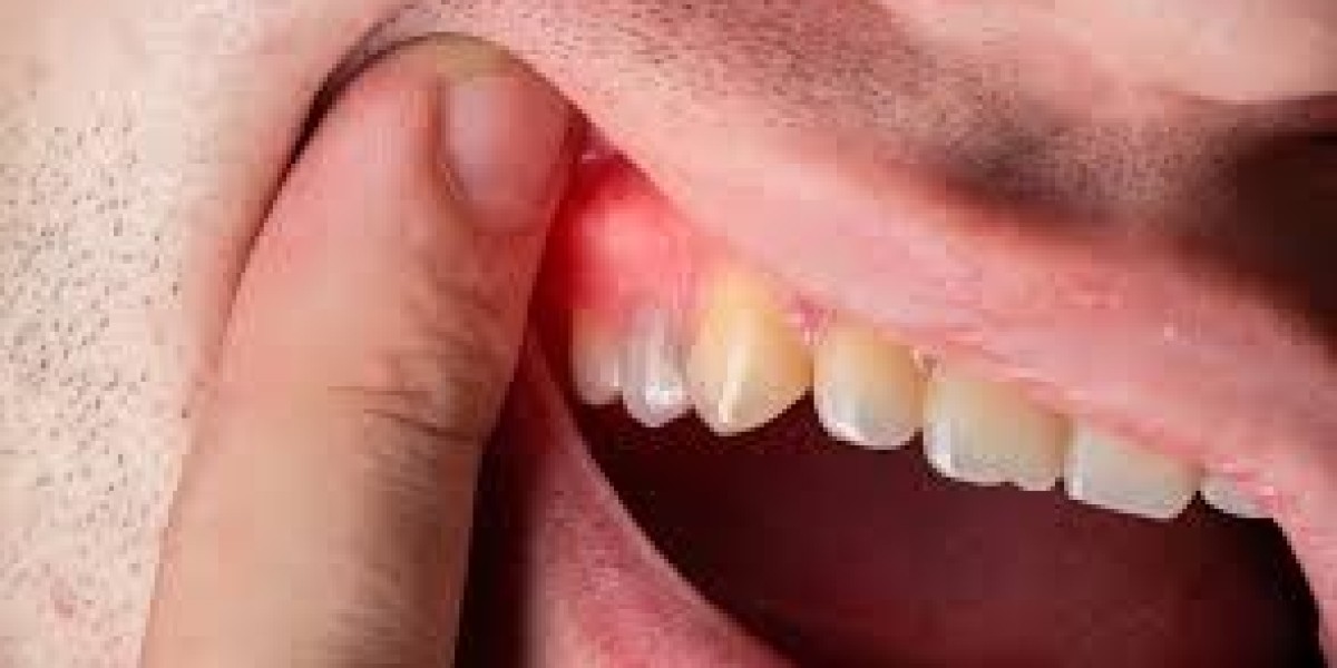 Can a Tooth Infection Go Away Without Antibiotics?